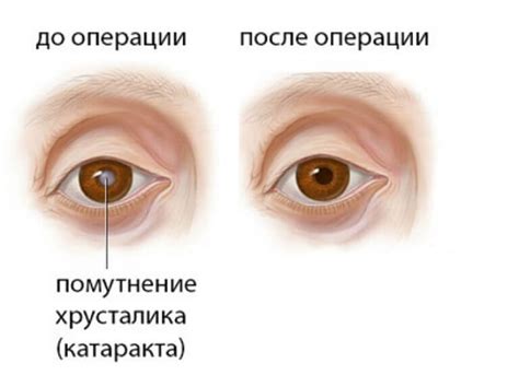 Миф: Зрение становится хуже после операции