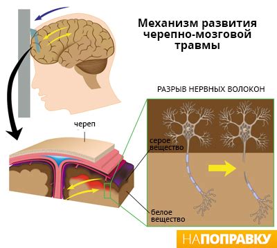 Мифы и факты о питье после сотрясения мозга