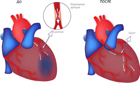 Мифы о вине после шунтирования сердца