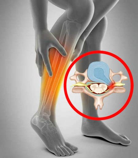 Могут ли ноги парализоваться при грыже позвоночника?