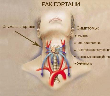 Может ли лор увидеть опухоль гортани?