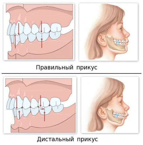 Может ли неправильный прикус вызвать хруст челюсти