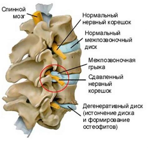 Может ли появиться защемление нерва в поясничном отделе позвоночника?