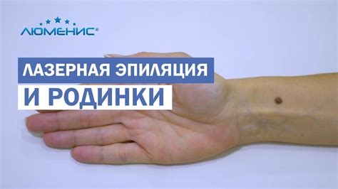 Можно ли делать лазерную эпиляцию с родинками