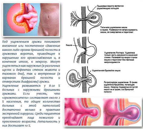 Научное объяснение причины увеличения живота при грыже