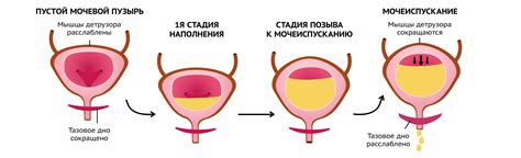 Недержание мочи и его последствия