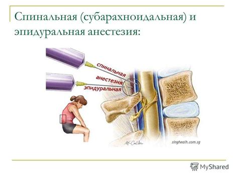 Недостатки эпидуральной анестезии при родах