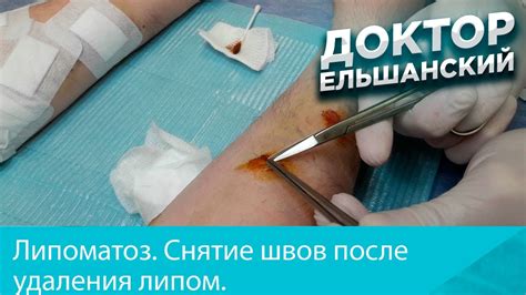 Неприятные ощущения и осложнения после удаления швов