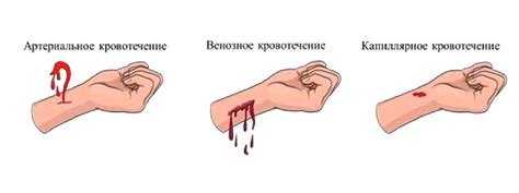 Не удаляйте перевязку, если остановка кровотечения достигнута