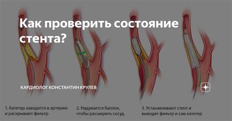 Ограничения при установке стента