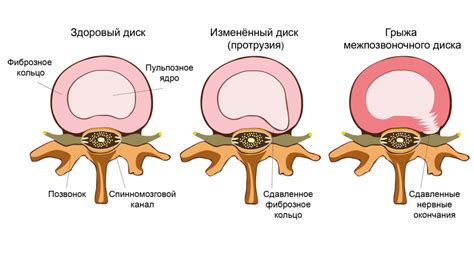 Онемение ноги и грыжа позвоночника: взаимосвязь и причины