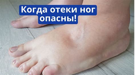 Опасны ли отеки ног после ходьбы