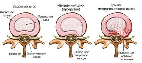 Определение грыжи позвоночника