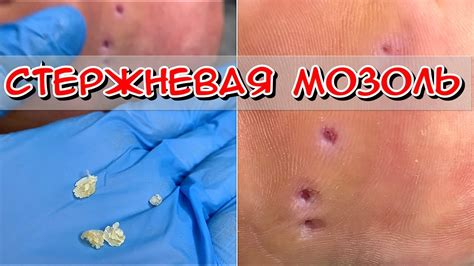 Основные правила прокалывания мозоли с кровью