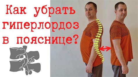 Основные причины гиперлордоза