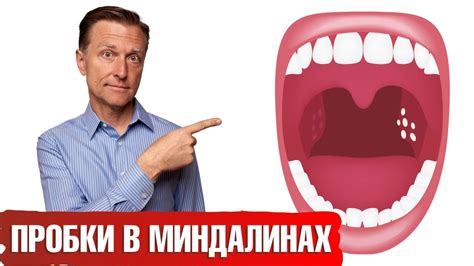 Основные причины образования белых пробок в гландах