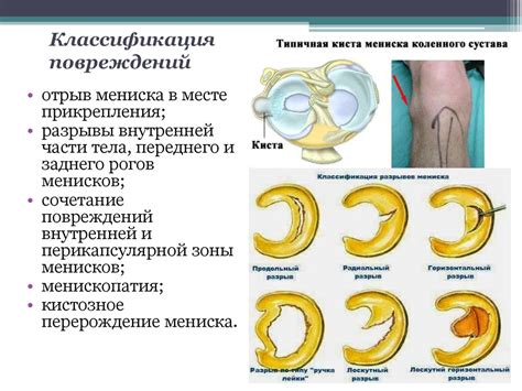 Основные причины повреждения мениска