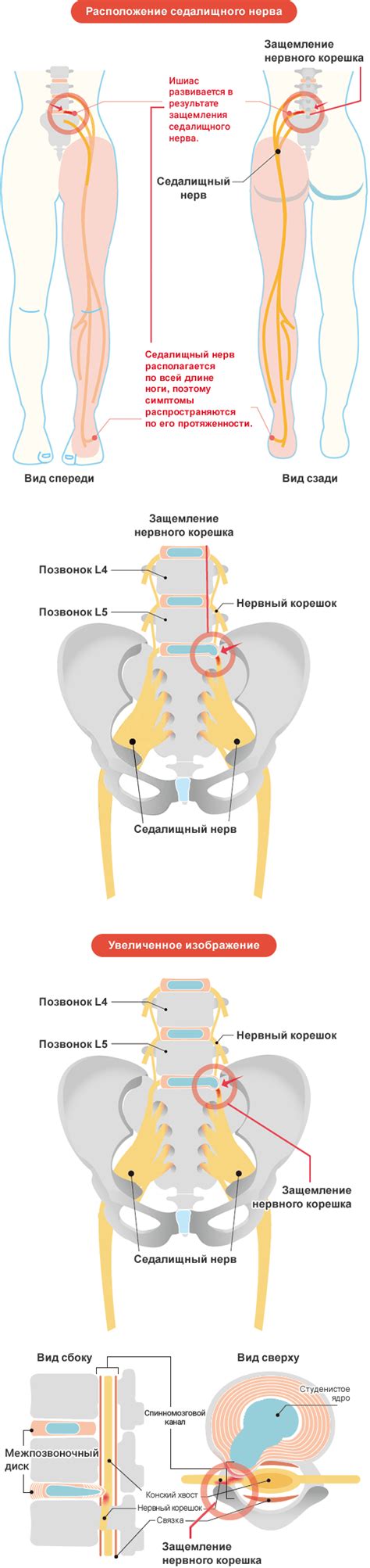 Основные симптомы ишиаса