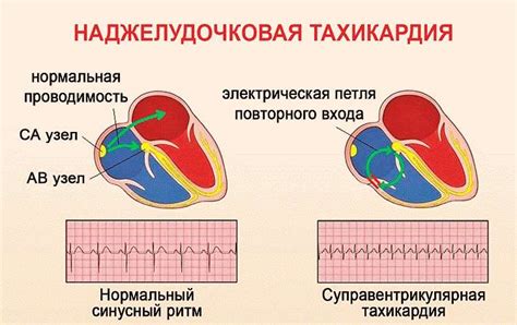 Основные симптомы тахикардии при употреблении энергетических напитков