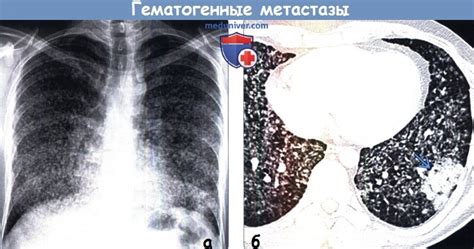 Особенности интерпретации результатов КТ при поиске метастазов в легких