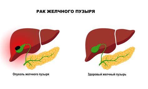 Отрыжка из-за желчного пузыря: причины и способы лечения