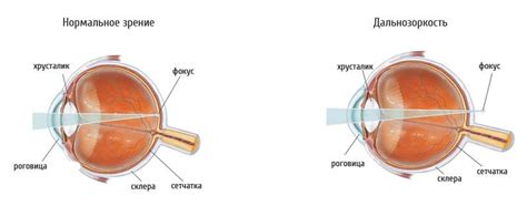 О дальнозоркости: причины и симптомы