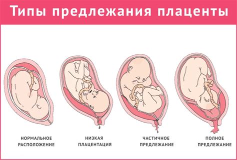 Передний расположение плаценты: что это такое?