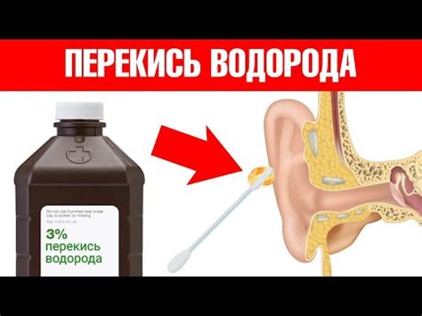 Перекись водорода для чистки ушей: вред или польза?