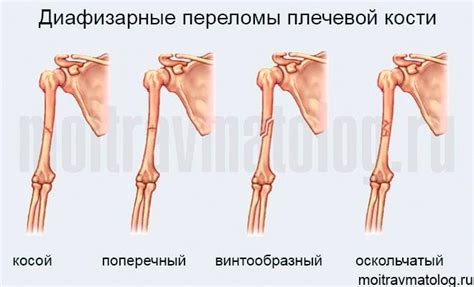 Перелом плеча