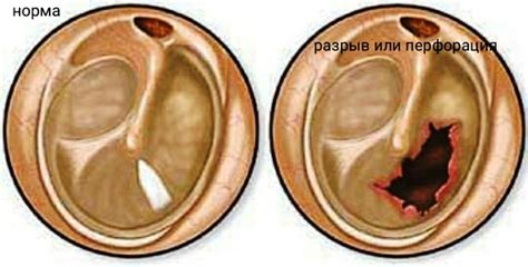 Перфорация барабанной перепонки