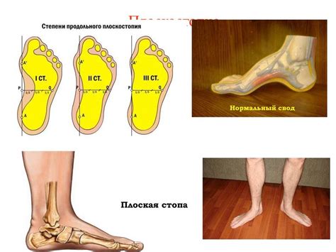 Плоскостопие и отекающие ноги: в чем связь?