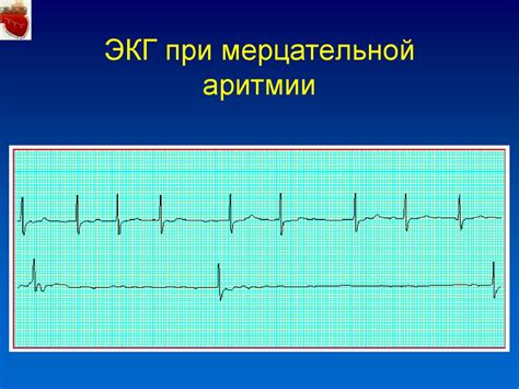 Плюсы и минусы парения при мерцательной аритмии