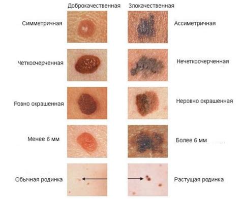 Повреждение кожи как фактор появления родинок