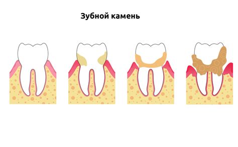 Повышенный риск образования зубного камня