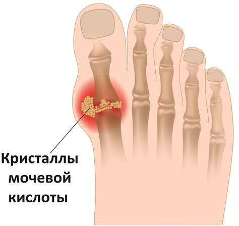 Подагра: проблемы и симптомы