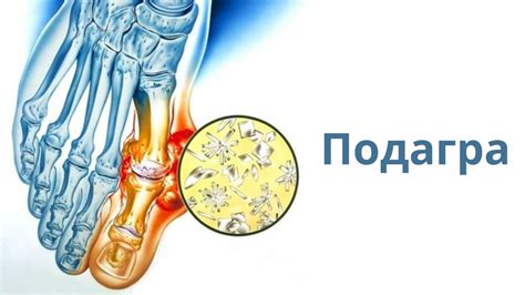 Подагра и ее особенности