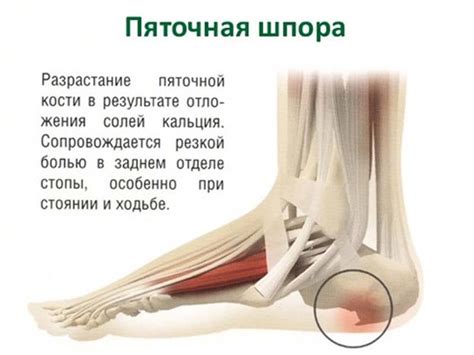 Подзаголовок 1: Что такое шпоры на пятках?