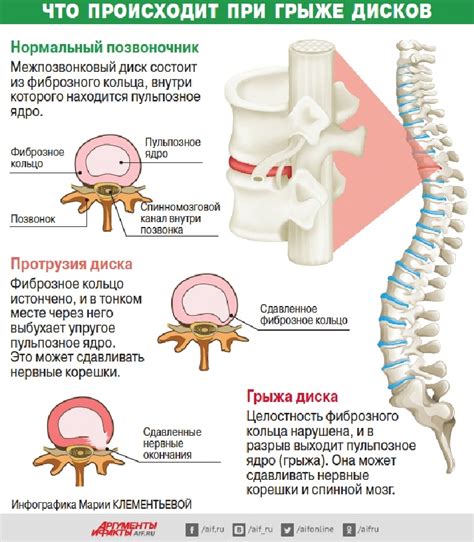 Показания для вправления позвонков при грыже