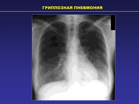 Показания для рентгена при исследовании изменений в легких