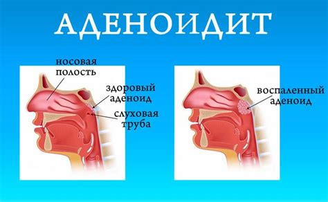 Полоскания после удаления миндалин у детей