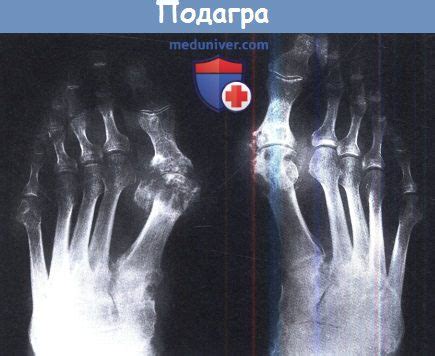 Понимание подагры и ее особенностей