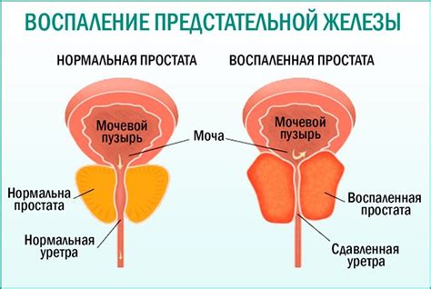 Понимание функций простаты и ее роль в организме мужчины