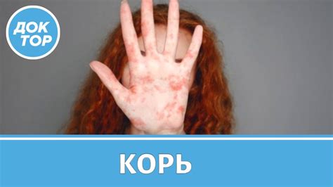 Последствия кори для взрослых