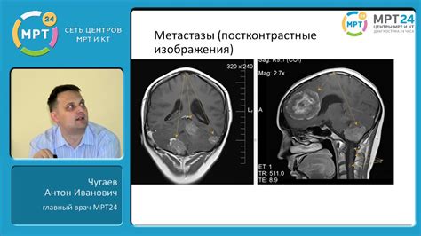 Последствия несвоевременного обнаружения и лечения опухоли мозга