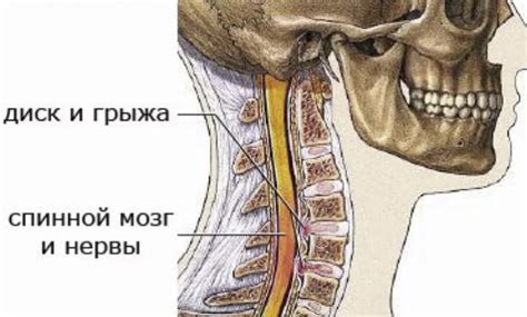 Последствия после вправления грыжи шейного отдела