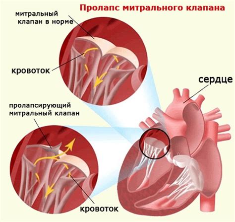 Последствия пролапса митрального клапана