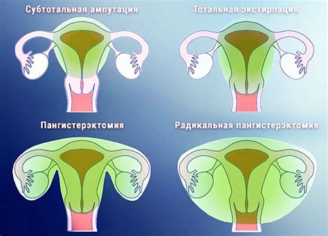 Последствия удаления матки