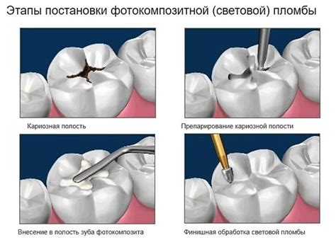 Постановка пломбы без анестезии: Часто задаваемые вопросы