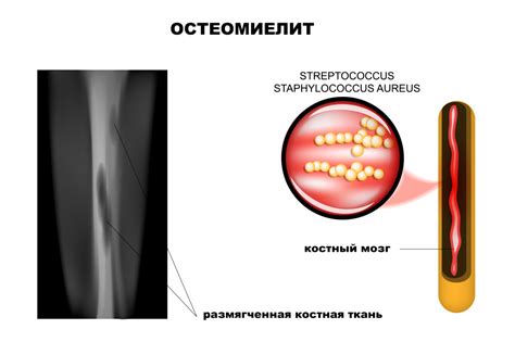 Посткоитальный остеомиелит