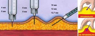 Правильная техника проведения уколов